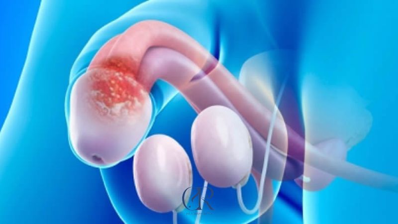 Cuánto dura la balanitis en el hombre