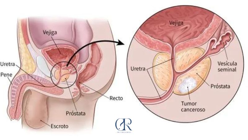 Cáncer de Próstata