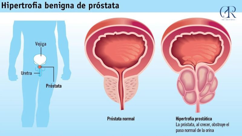 Hiperplasia Benigna de Próstata