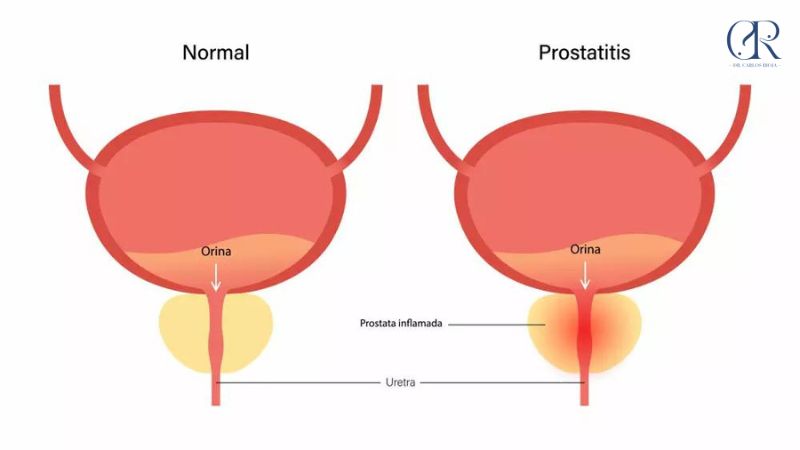 Prostatitis