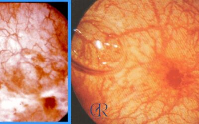 Cistitis crónica: causas, daños en la vejiga y tratamiento